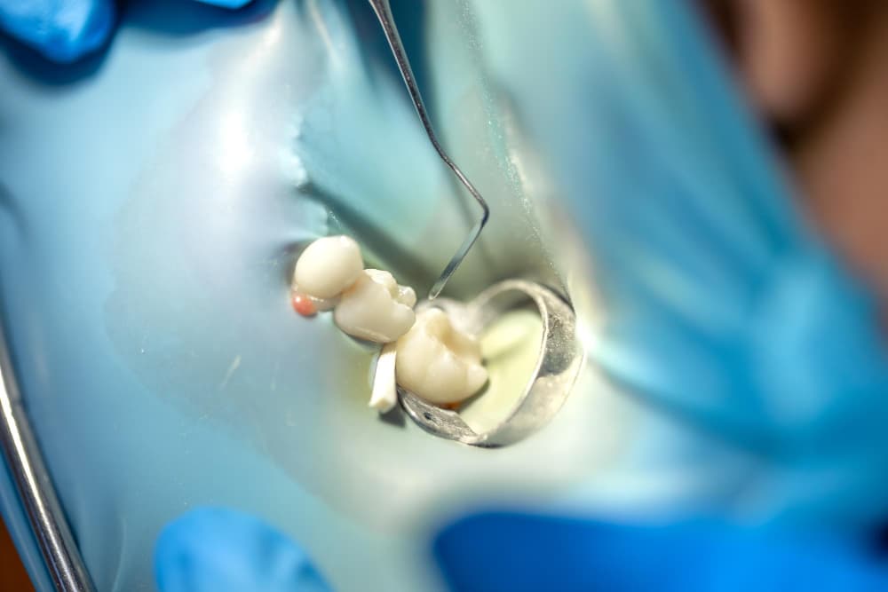 Dentista durante un trattamento di endodonzia in Albania presso Tarja Dental con strumenti rotanti avanzati