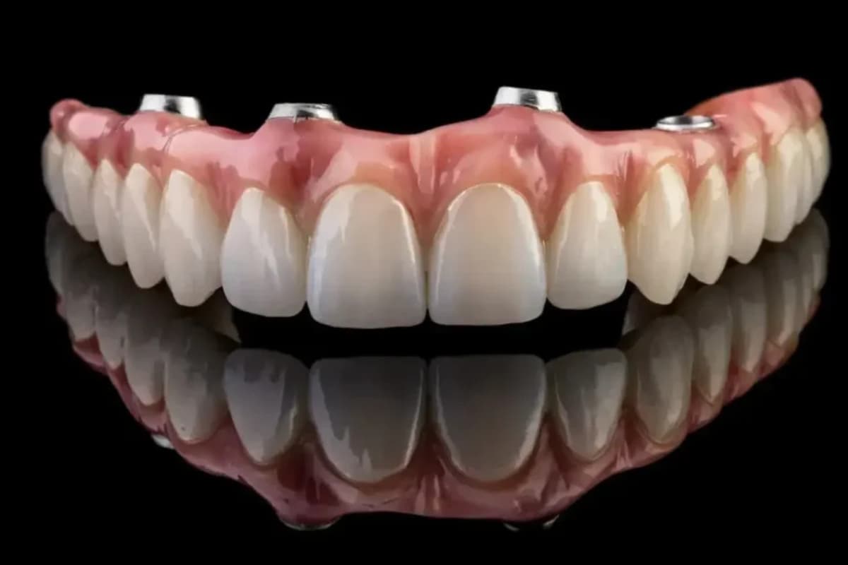 All on 4 dental implant procedure in Albania at Tarja Dental with digital planning