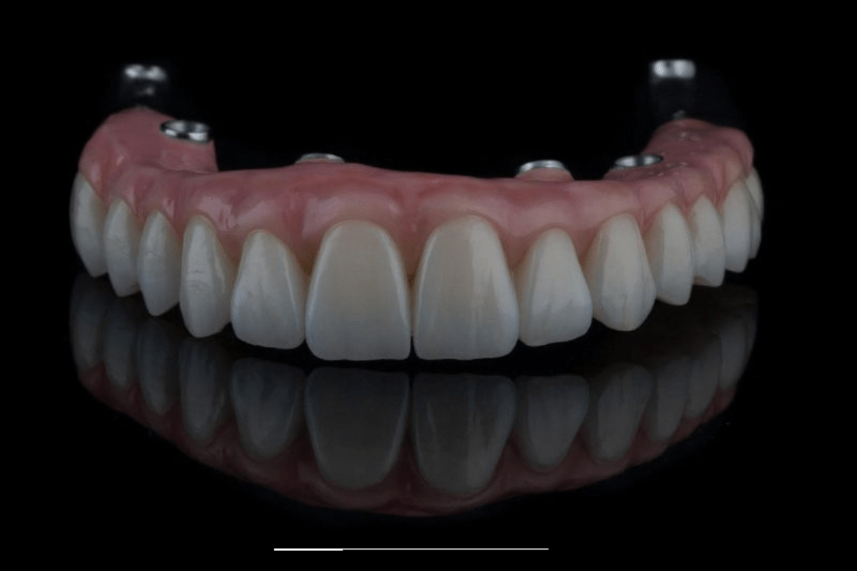 Expert consultation for All on 6 dental implants at Tarja Dental Clinic in Albania