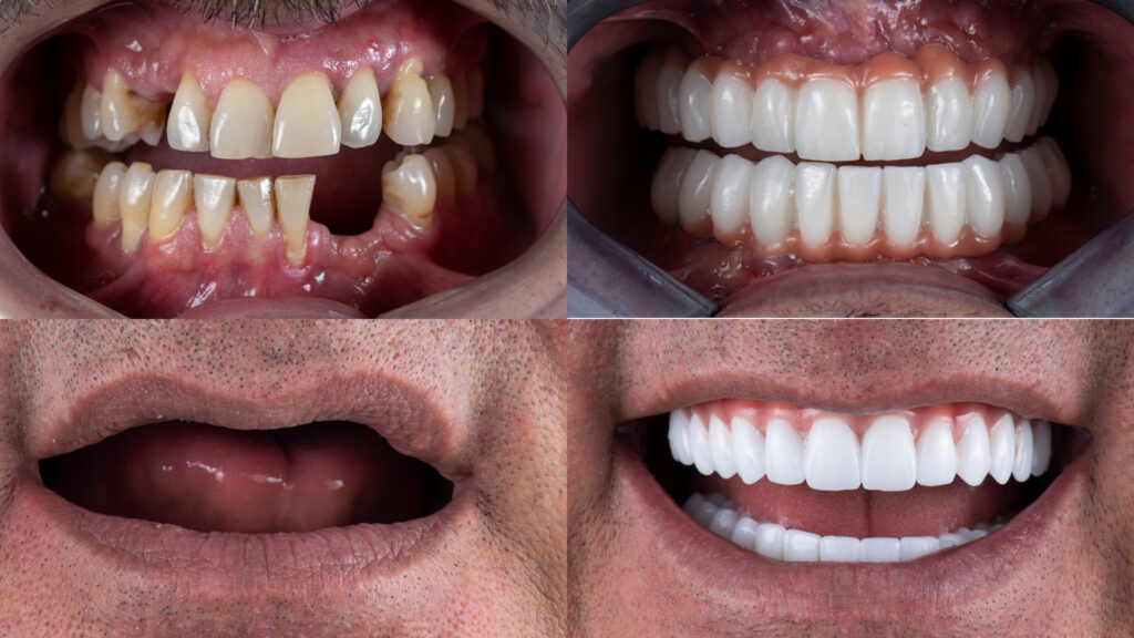 The United Kingdom is well known for having some of the highest dental implant prices in Europe, largely due to high overhead costs for clinics, elevated dentist salaries, and significant taxation in the private healthcare sector. Since implants are not covered by the NHS (except in rare medical circumstances), patients must pay entirely out of pocket — and the numbers are substantial.