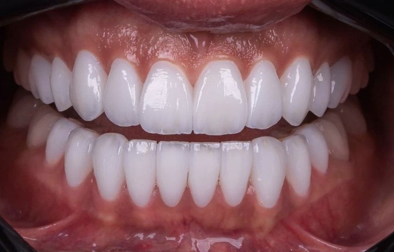 Hollywood Smile në Durrës me dhëmbë të bardhë perfekt pas trajtimit estetik tek Tarja Dental.