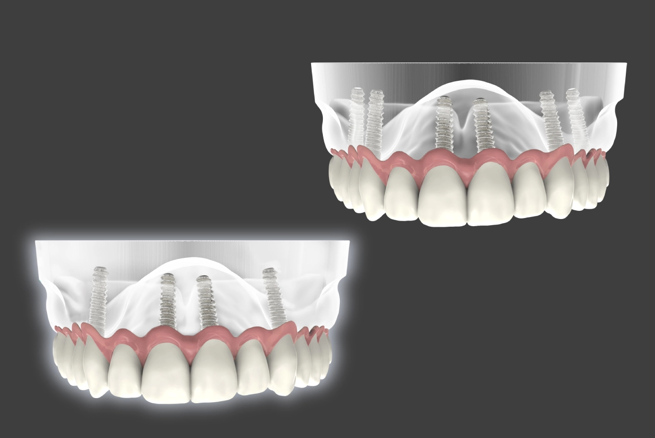 Kush është diferenca All-on-4 vs All-on-6?