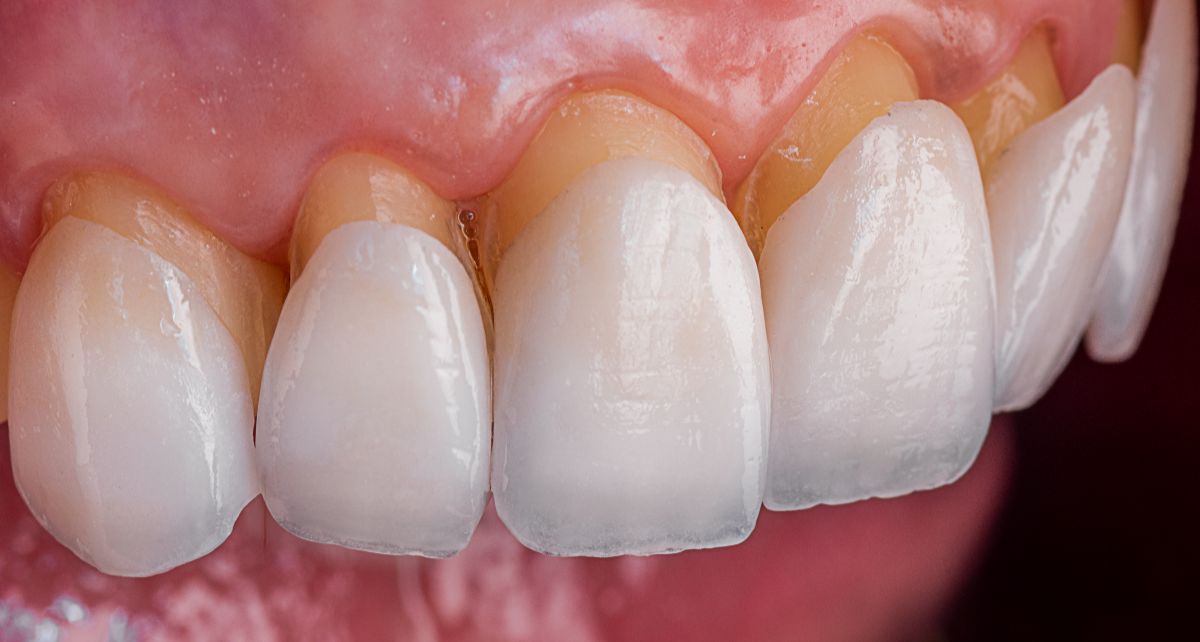 Procedura profesionale e Hollywood Smile në Durrës duke vendosur faseta dentare.