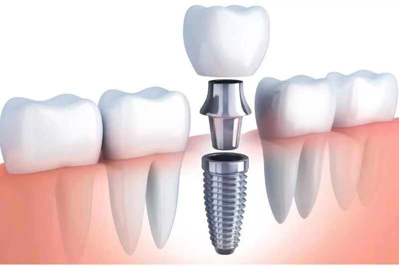 Dentists in Albania often receive part of their training abroad in Italy, Germany, or Switzerland and bring this expertise back home, ensuring that patients benefit from the same level of professionalism and technology. The lower cost of living, reduced taxation, and high demand for dental tourism make it possible for clinics to offer world-class implantology at significantly reduced rates. For international patients, this means access to the same quality of care they would expect in London, Berlin, or Milan, but at a fraction of the price.