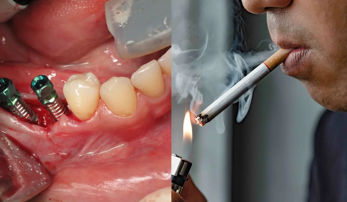 Sa zgjat shërimi pas implantit dentar për duhanpirës?