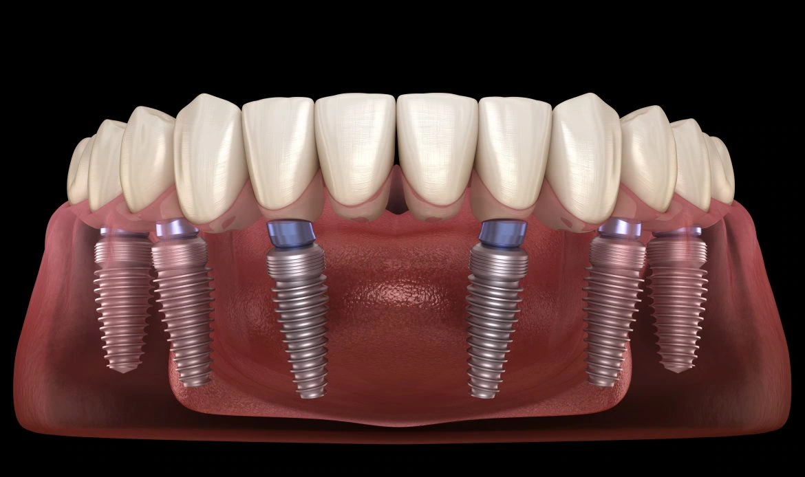 Instead of replacing each missing tooth with a single implant (a costly and lengthy process), the All on 6 method uses six strategically placed implants in the jawbone to support a full arch of fixed teeth. Think of it as building a strong foundation with fewer, well-positioned supports.