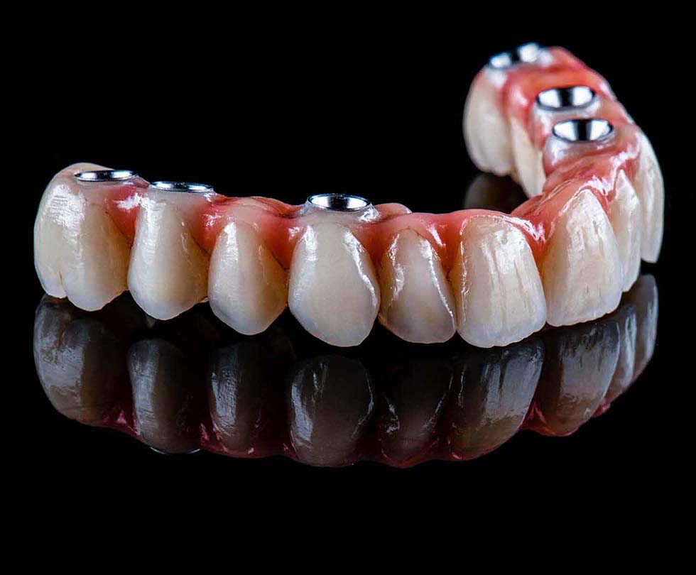 The Advantages of All on 6 Implants