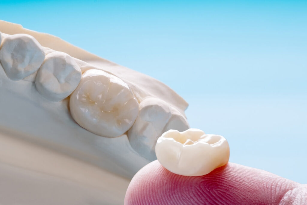 Scopri che cos’è la corona dentale, quando serve, quali tipi esistono e quanto costa. Tarja Dental Clinic in Albania offre trattamenti sicuri e prezzi competitivi.
