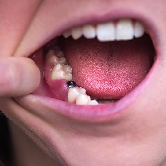 Scopri come capire se un impianto dentale ha fatto infezione: sintomi da non ignorare, cause e cure. Tarja Dental Clinic a Durazzo offre assistenza sicura.