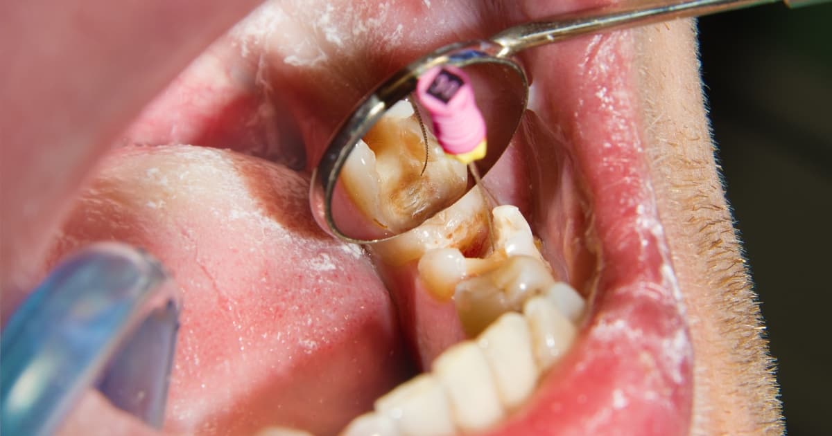 Trajtim kanalor gjatë procedurës së endodoncias në Durrës për shpëtimin e dhëmbit natyral.