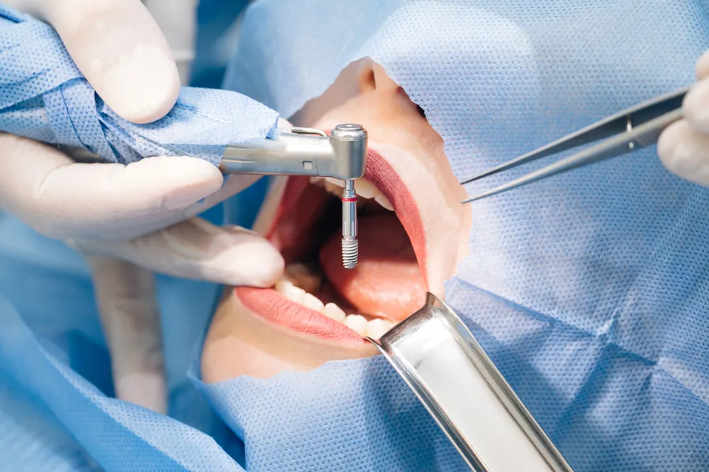 Scopri quanto tempo ci vuole per fare un impianto dentale: dall’intervento di 30 minuti all’osteointegrazione di 3–6 mesi. Con Tarja Dental Clinic il percorso è sicuro e personalizzato.