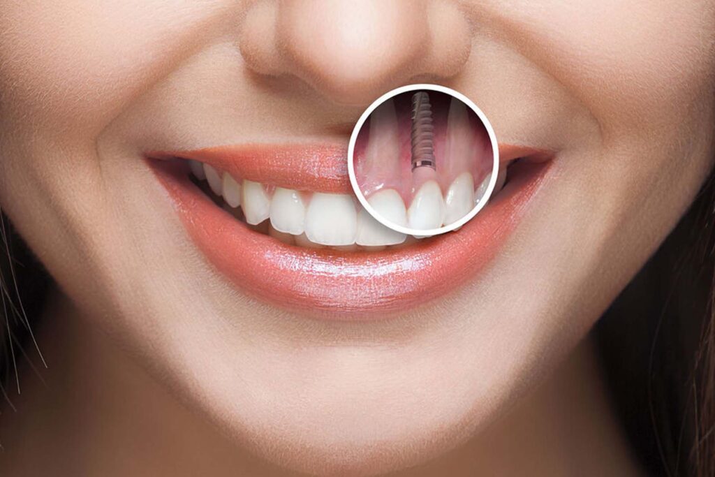 Scopri come funziona un impianto dentale: fasi, materiali, tempi e costi. Tarja Dental Clinic a Durazzo offre impianti dentali sicuri e certificati a prezzi competitivi.