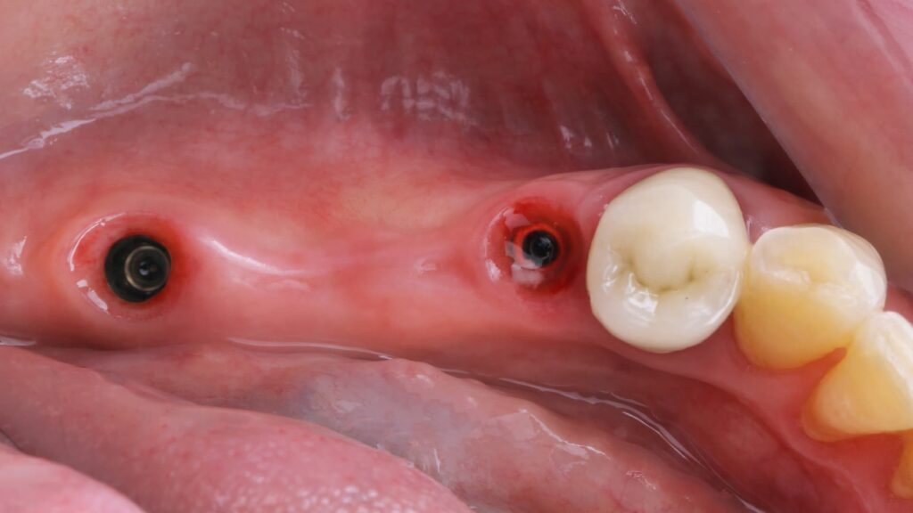 Wondering how long recovery from dental implants takes? Learn the full healing timeline, stages, and aftercare tips from experts at Tarja Dental Clinic in Albania.