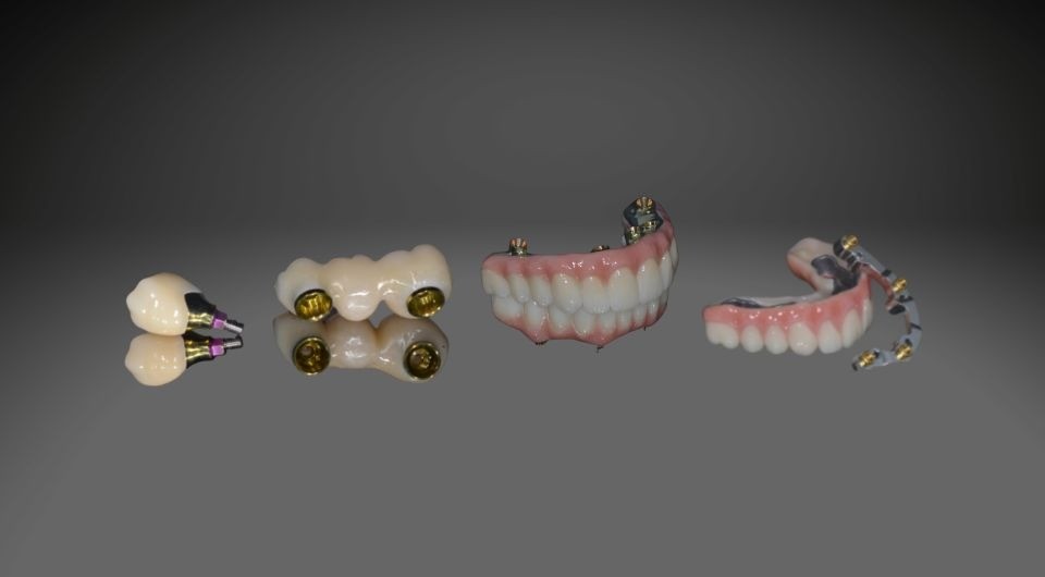 Ein Implantat, das präzise gesetzt wird, hat die besten Chancen, ein Leben lang zu halten. Ein erfahrener Implantologe arbeitet nicht „auf Sicht“, sondern mit digitalen 3D-Planungen, navigierter Chirurgie und modernen Instrumenten. Dadurch werden die Position, die Tiefe und der Winkel exakt bestimmt. Fehler bei der Platzierung können später zu Überlastungen, Lockerungen oder sogar zum Verlust des Implantats führen. Deshalb spielt die Kompetenz der behandelnden Klinik eine zentrale Rolle.