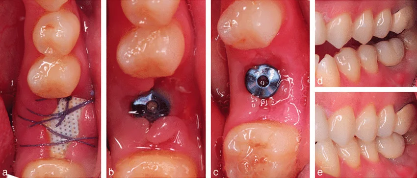 Not every patient heals at the same pace. These key factors determine how long your recovery will take: Overall Health – Patients with strong immune systems and good oral health recover faster. Conditions like diabetes or autoimmune disorders can slow healing. Bone Density – A healthy, dense jawbone supports faster osseointegration. If a bone graft was required, healing takes longer. Smoking and Alcohol – Both can reduce blood flow and oxygen levels, increasing the risk of complications and delaying recovery. Number of Implants – A single implant heals faster than multiple implants or full-arch reconstructions. Surgical Technique – Clinics that use digital planning and minimally invasive surgery reduce trauma and promote faster recovery.