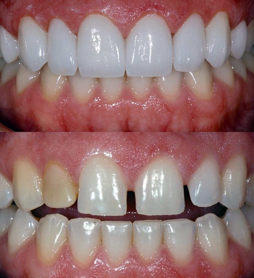 Advantages of Porcelain Crowns