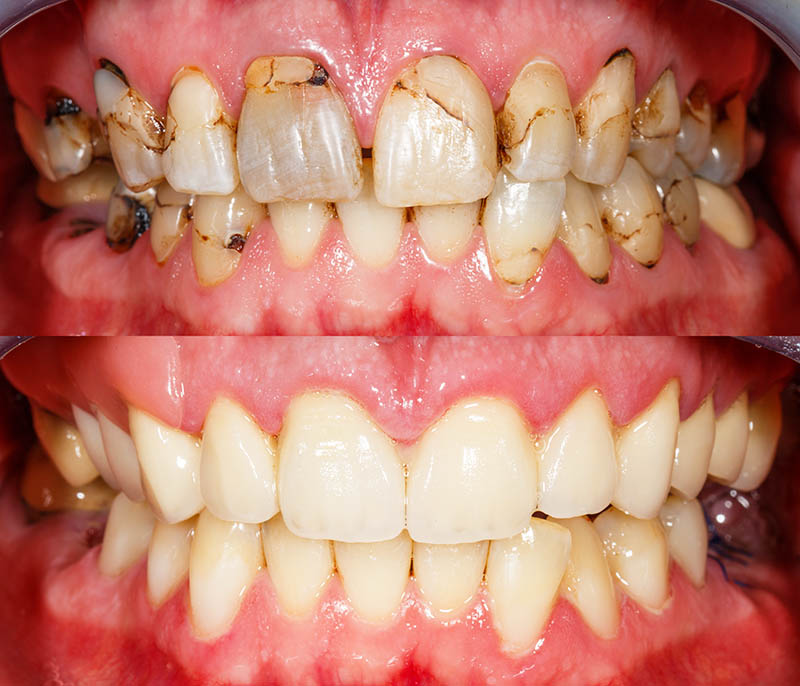 Tipologie di riabilitazione completa