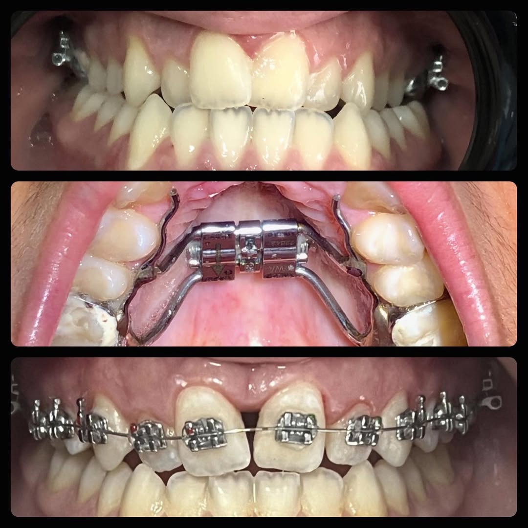Braces before and after results – orthodontics in Albania
