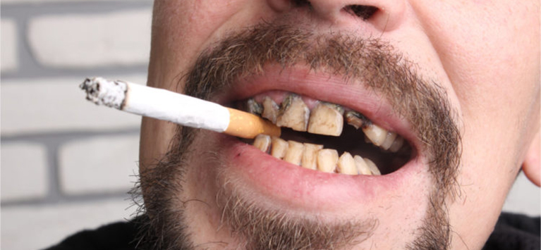 Tobacco use is catastrophic for oral health, it affects not only the teeth but also the entire mouth.
