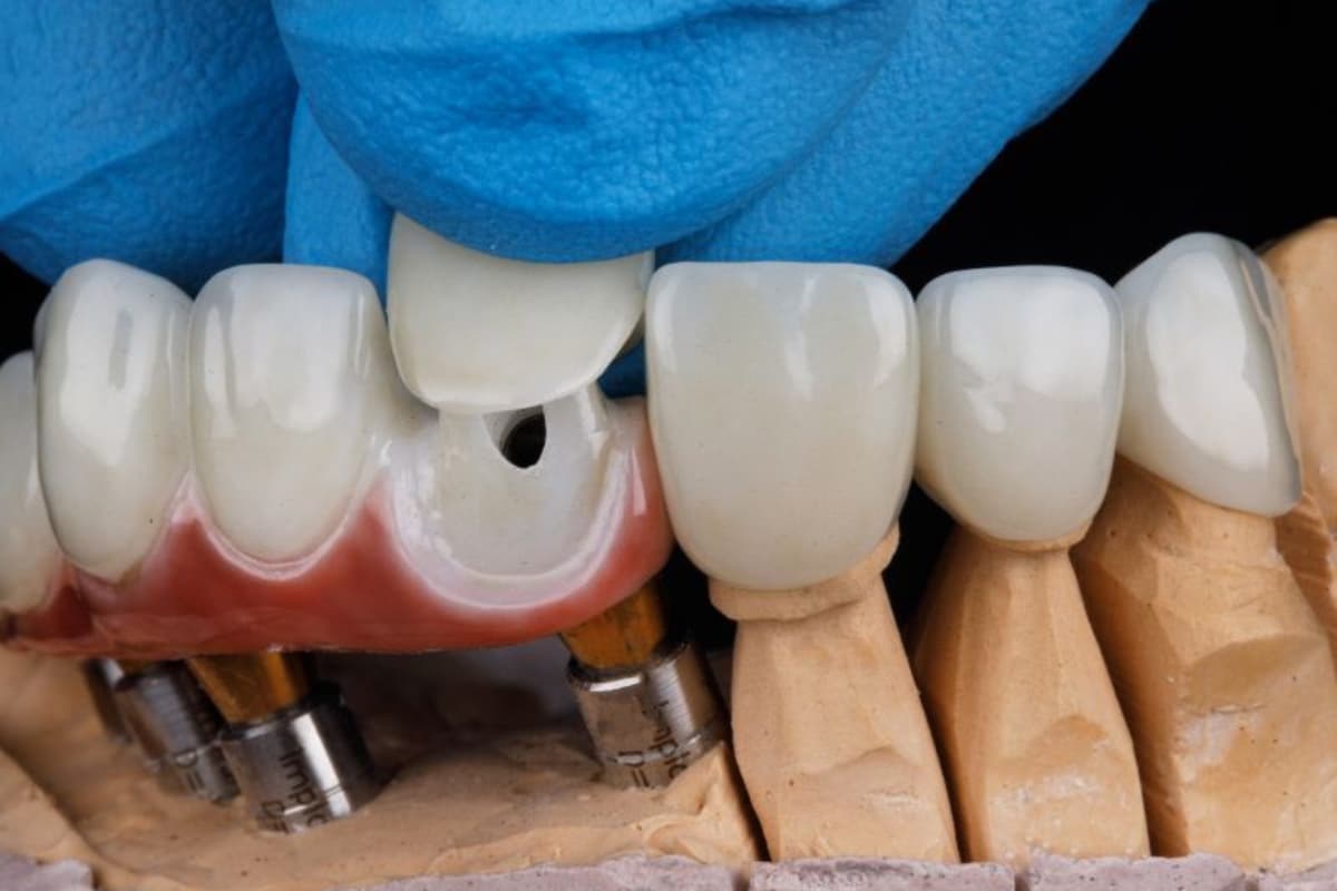 Hochwertige Zahnkronen in Albanien bei Tarja Dental Clinic – präzise Anpassung von Zirkon- und Keramikkronen