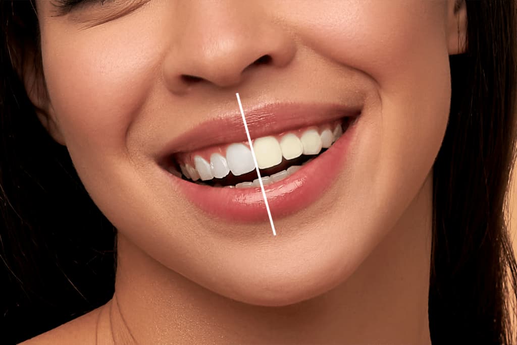 Professional teeth whitening is one of the simplest and most affordable procedures for dental tourists. Clinics abroad use advanced laser and LED systems to safely remove deep stains in just one session.