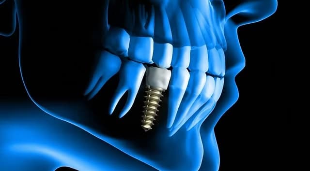 Bei komplexeren Eingriffen wie All-on-4 oder All-on-6 (feste Brücken auf 4 bzw. 6 Implantaten) liegen die Gesamtkosten deutlich höher – zwischen 10.000 und 20.000 Euro pro Kiefer.
