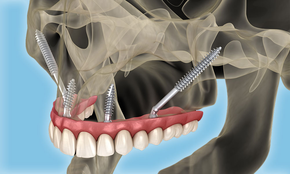 Zygomatic implants are a specialized solution for patients with severe bone loss in the upper jaw where traditional implants aren’t possible. Instead of being anchored in the jawbone, these longer implants are fixed into the zygoma (cheekbone), which provides a strong, dense foundation.