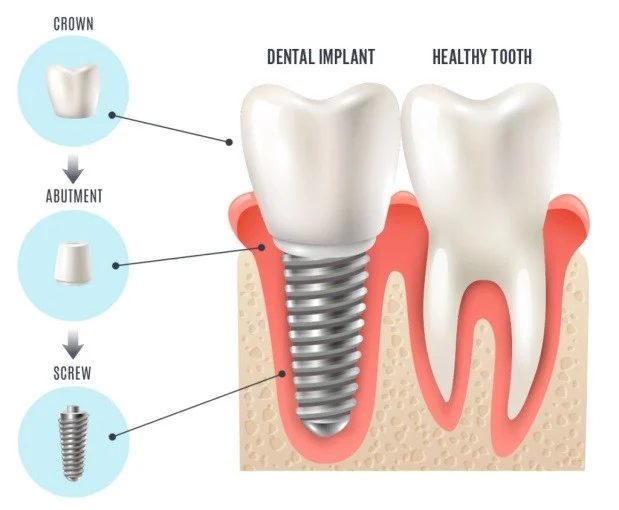 A dental implant consists of a small titanium or zirconia screw inserted into the jawbone. Over time, the bone fuses with the implant in a natural process called osseointegration. This creates a solid foundation for the final crown or bridge.