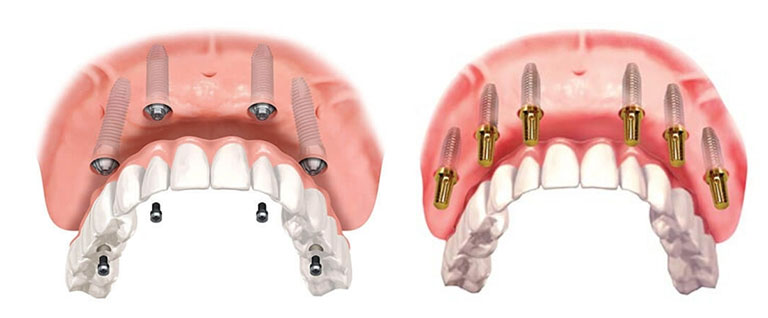Another sought-after procedure among international patients is the All-on-4 or All-on-6 dental implant system. This innovative method allows patients with multiple missing teeth to receive a complete fixed set of teeth in just a few days.