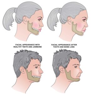 One of the most serious consequences of leaving a missing tooth untreated is bone resorption  the gradual shrinking of the jawbone.