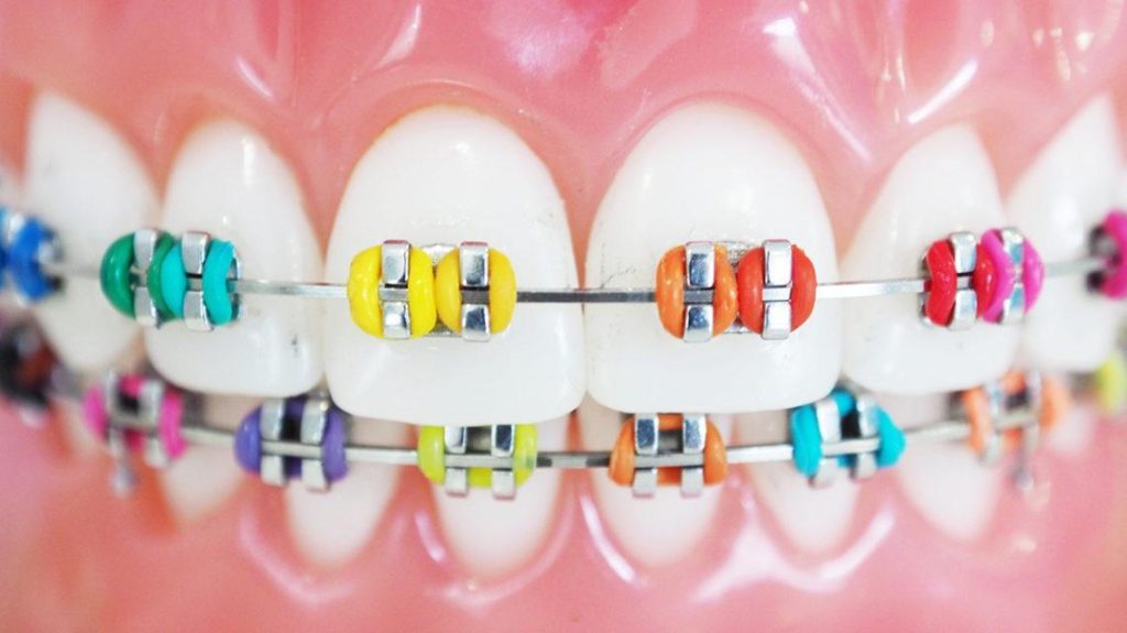 Wondering if dental braces hurt? Learn what to expect, how long discomfort lasts, and how modern orthodonticsare are at Tarja Dental Clinic