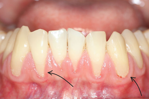 Many people believe that brushing harder means cleaner teeth — but excessive force actually wears away enamel and irritates gums.
