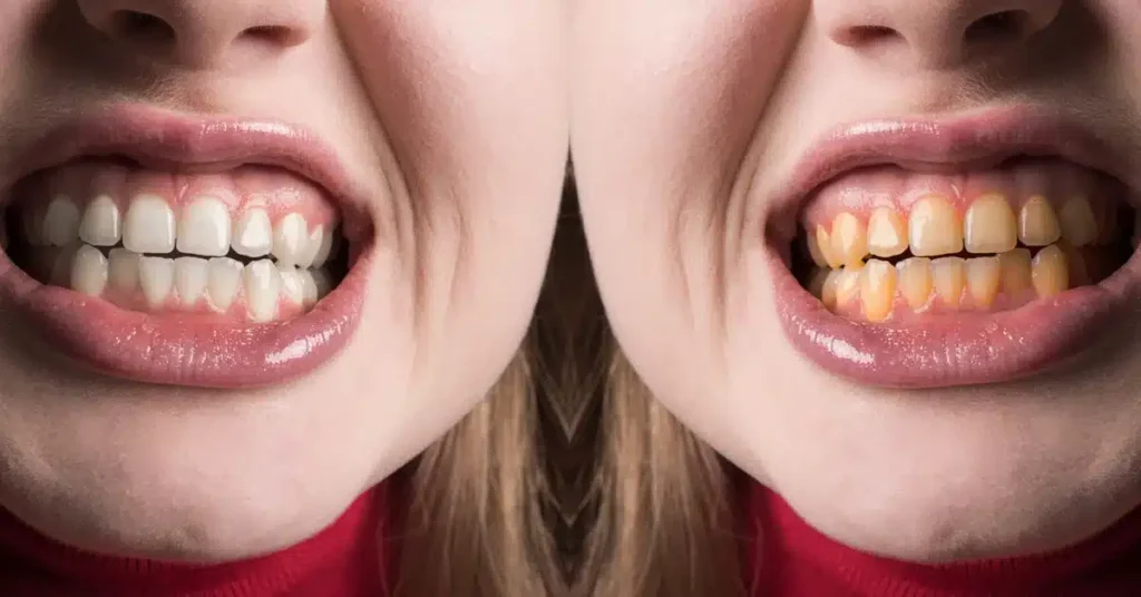 Trattamento di sbiancamento dentale LED presso Tarja Dental Clinic in Albania.