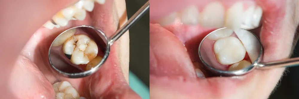 Modern dentistry offers a wide range of procedures, but not all are suitable for everyone. Let’s look at the main categories.