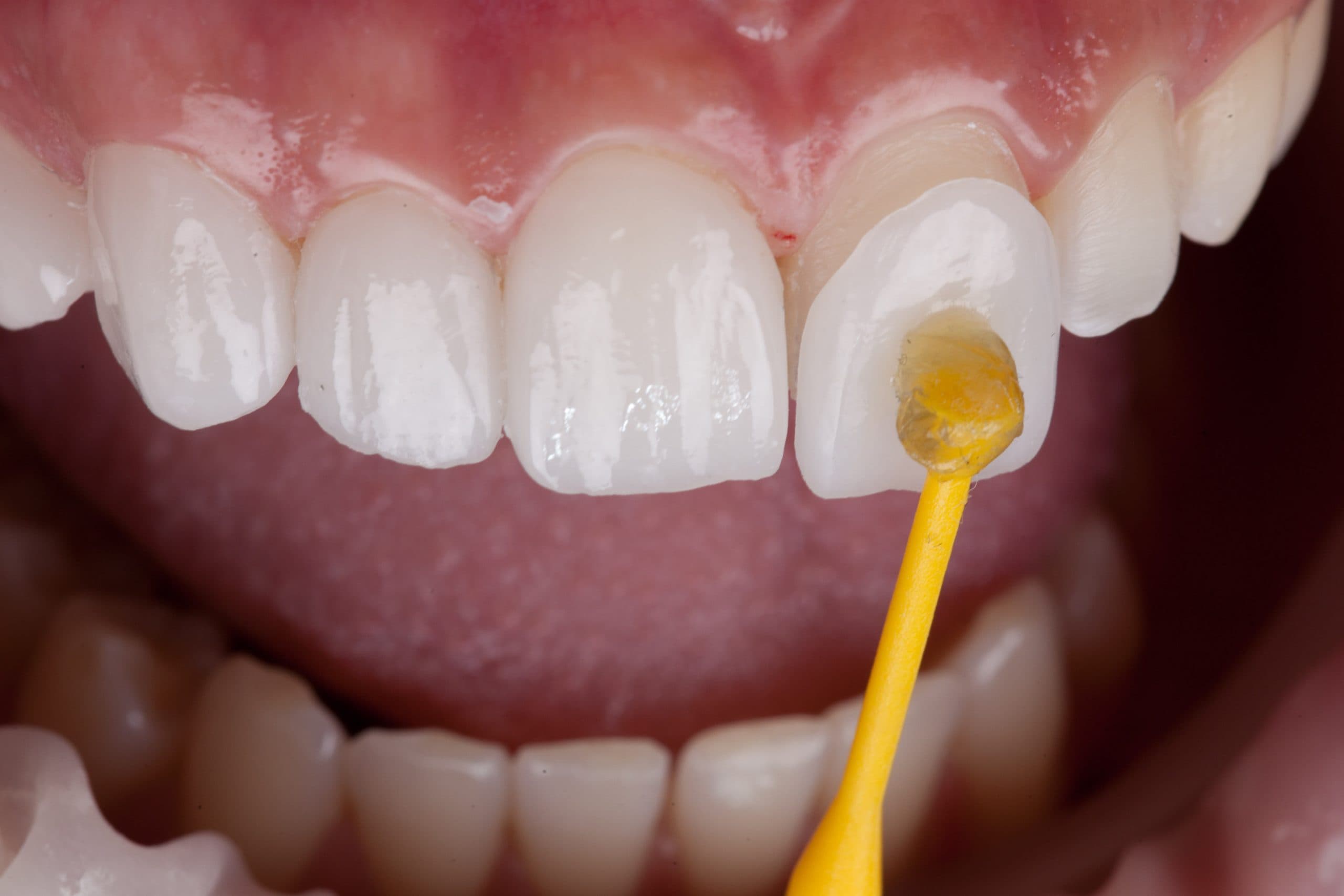 Porcelain veneers are thin shells placed on the front of the teeth to create a flawless, white smile. They’re one of the most popular cosmetic dental procedures among dental tourists seeking a Hollywood-style transformation.