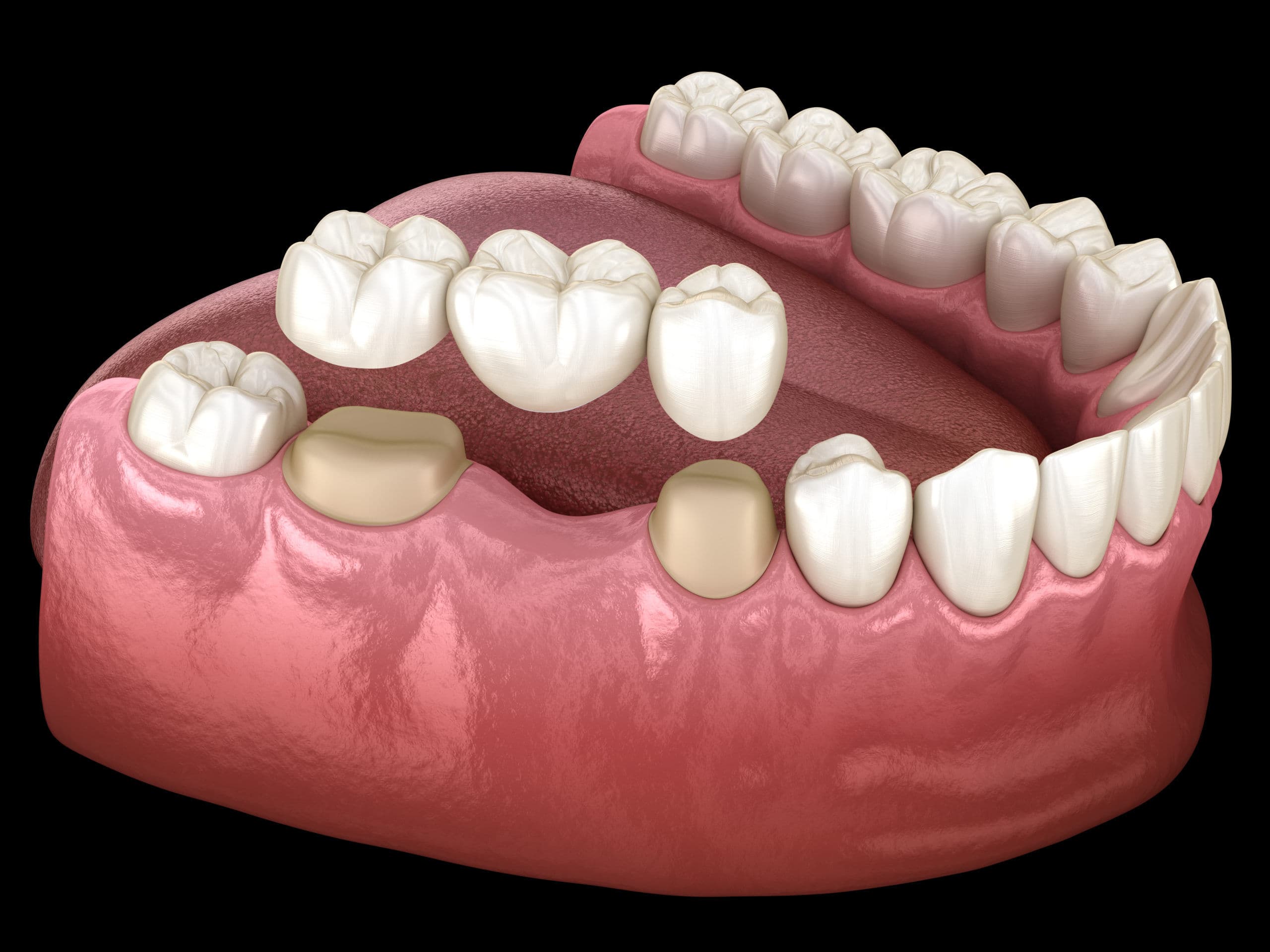 Crowns and bridges are another cornerstone of dental tourism. These restorations are used to strengthen damaged teeth or replace missing ones without surgery.