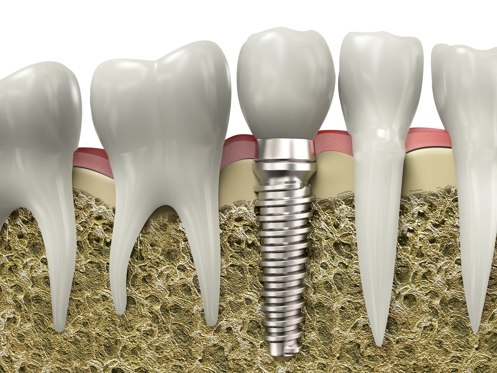Dental implants are by far the most requested treatment among dental tourists. They provide a permanent, natural-looking solution for missing teeth by replacing the tooth root with a titanium or zirconia post that fuses with the bone.