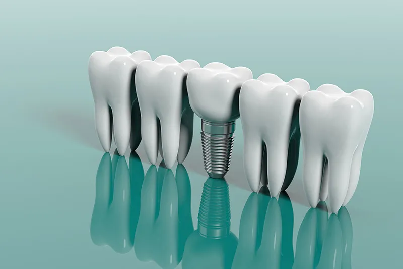 Endosteal implants are the most widely used type and are considered the gold standard in implant dentistry. They are shaped like small screws or cylinders and are placed directly into the jawbone. After the bone heals and integrates with the implant, a custom crown is attached on top.