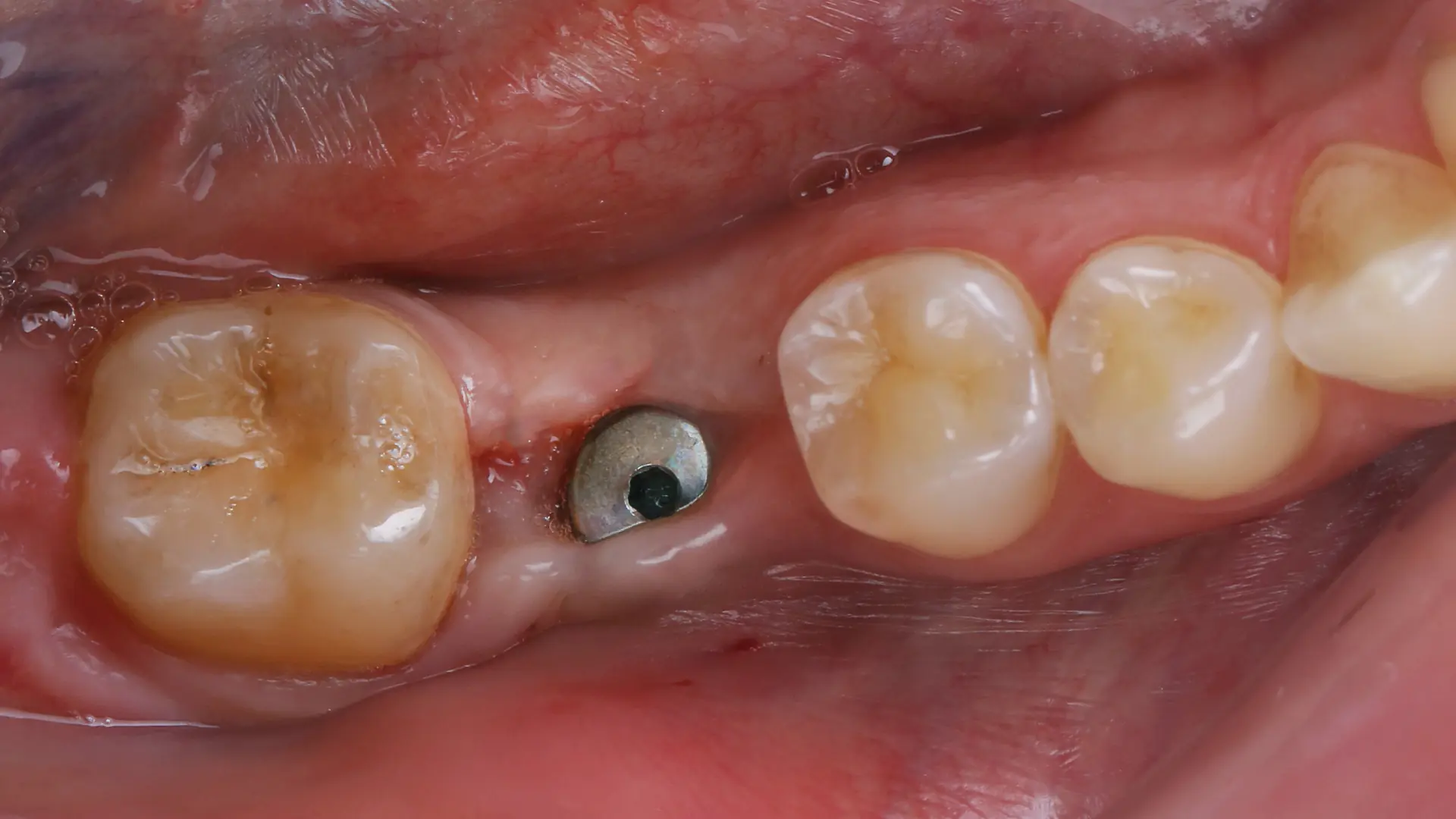 Was kosten Zahnimplantate in Albanien? Der vollständige Preis- und Behandlungsführer 2025