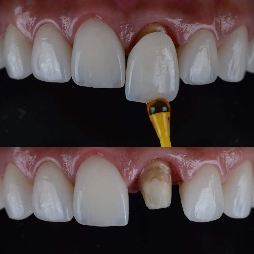 At Tarja Dental, crowns are digitally milled with CAD/CAM technology, ensuring precision, comfort, and aesthetics.