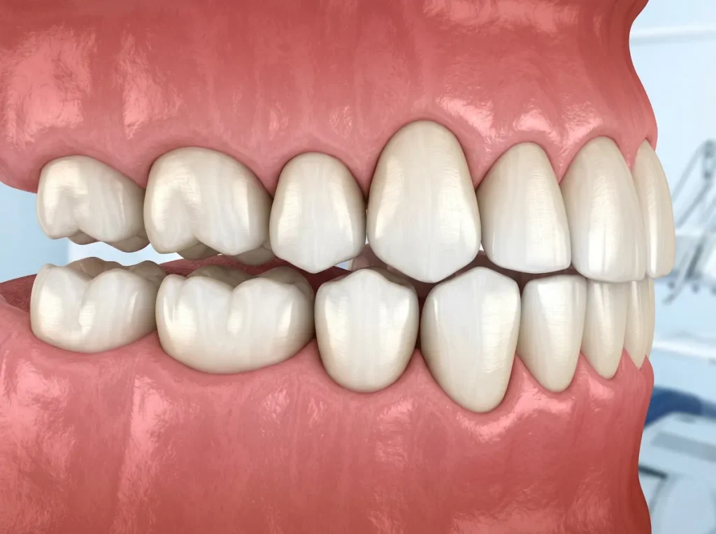 Denti in zirconia pesanti dopo l’applicazione? Scopri quando è normale adattarsi e quali segnali richiedono il controllo del dentista.