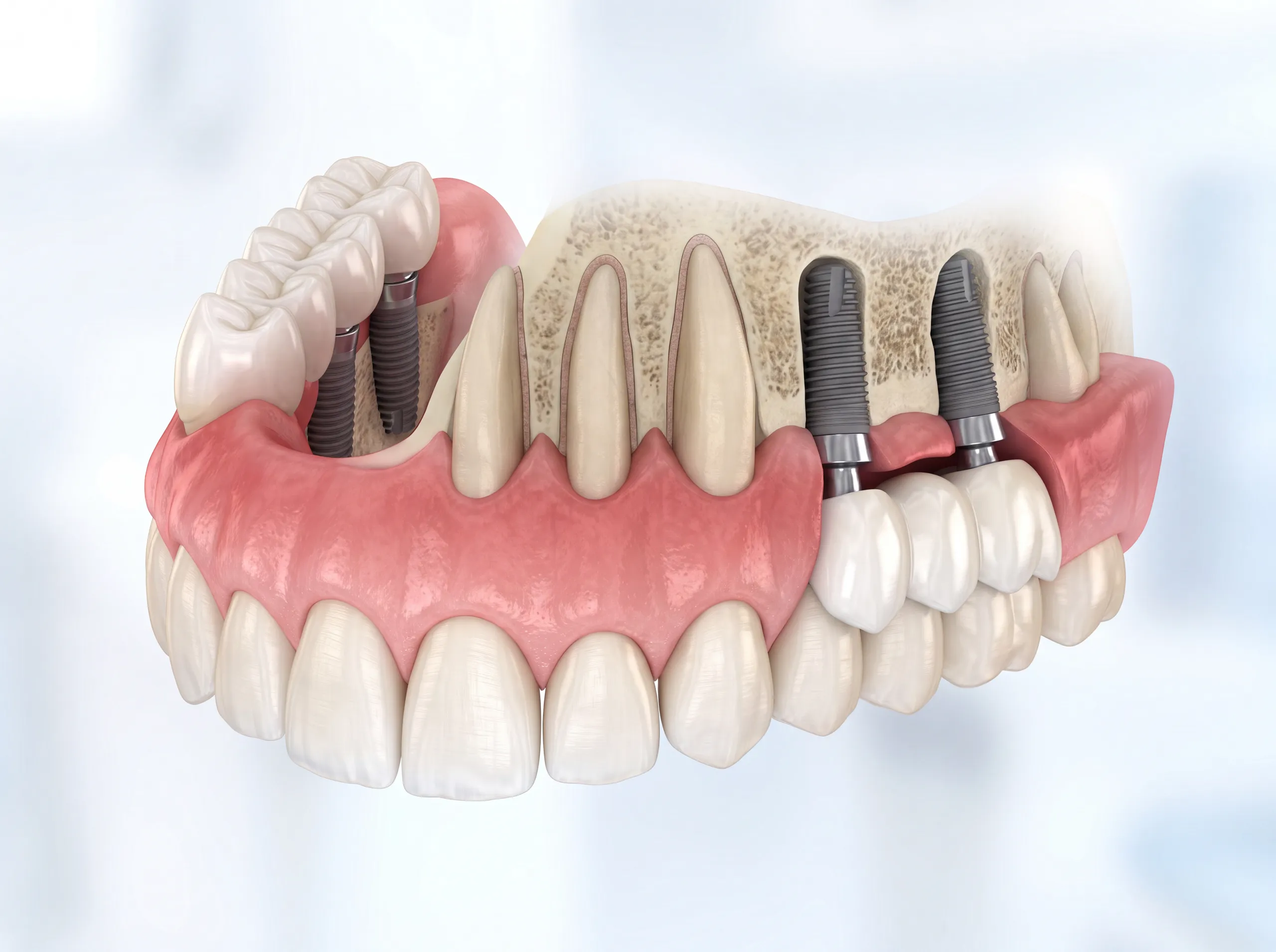 Se mi sono rimasti solo i denti anteriori, posso mettere degli impianti dentali per sostituire quelli mancanti?
