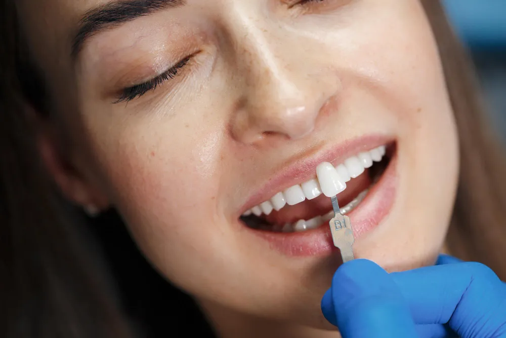 Facettes dentaires en Albanie chez Tarja Dental