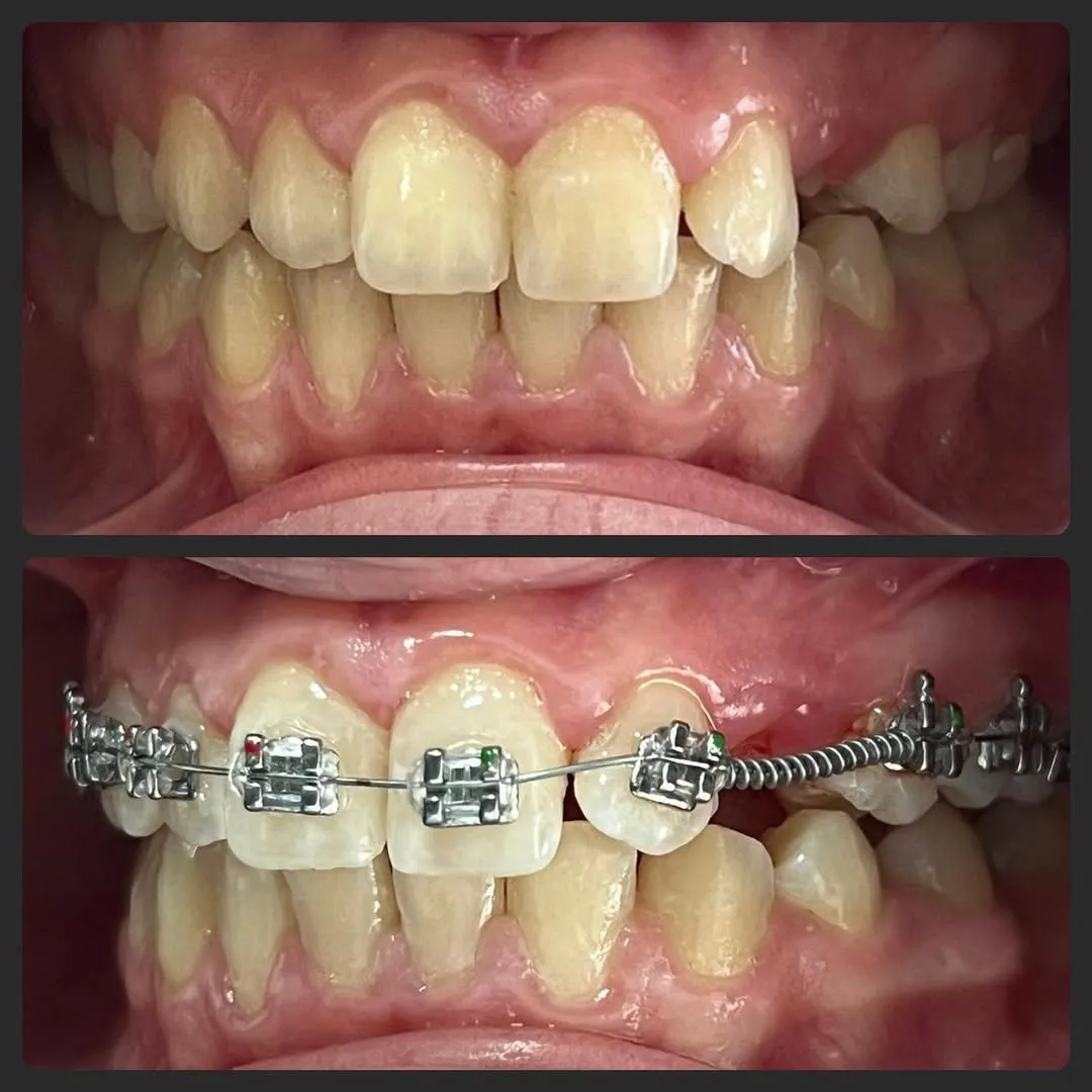 Appareil orthodontique en céramique pour un sourire plus harmonieux