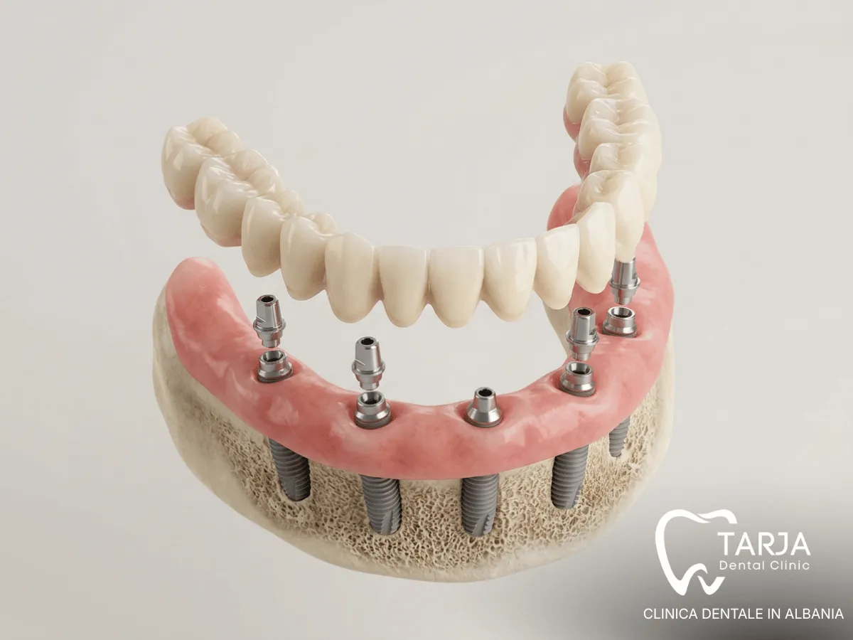 All-on-4 e All-on-6 per denti fissi su un’arcata con poco osso