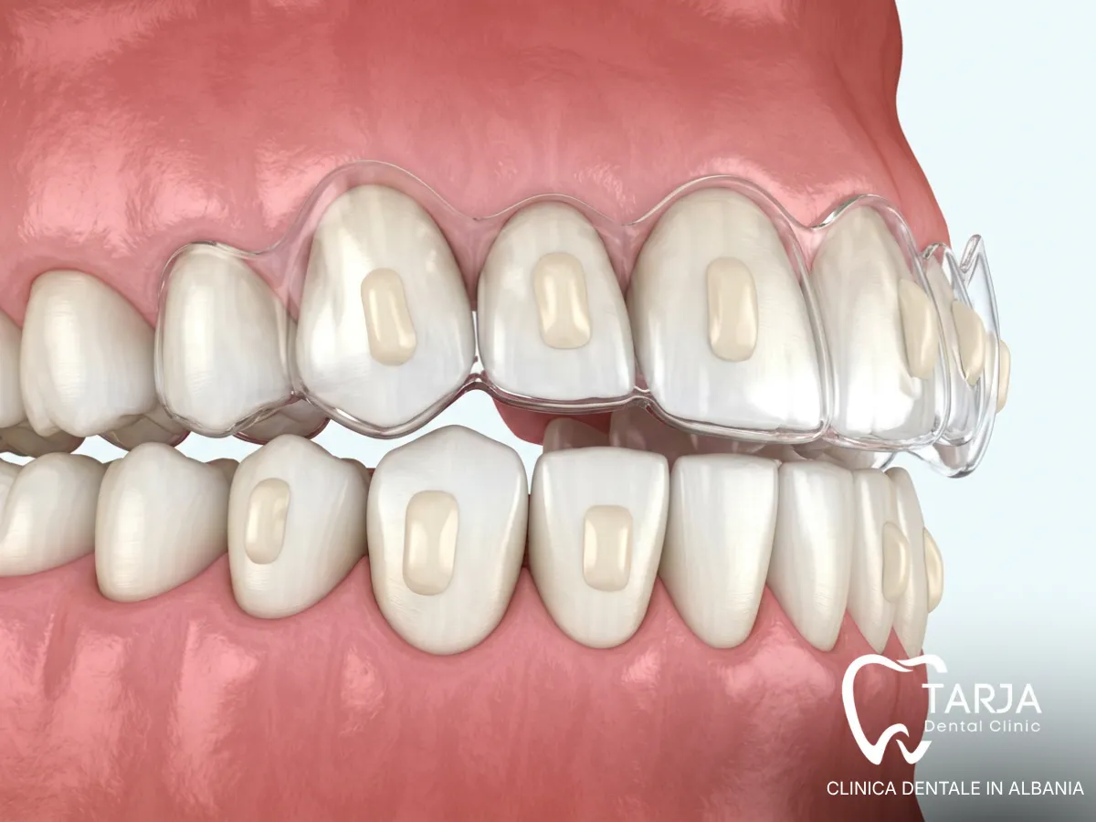 Attachment ortodontici e spazio tra i denti durante il trattamento con mascherine trasparenti