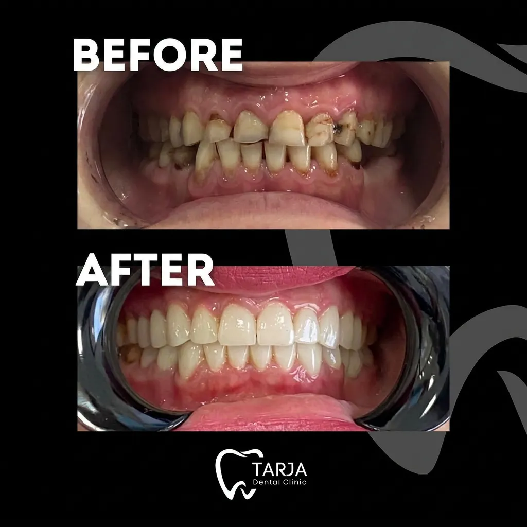 E-Max veneers Albania patient with dentist at Tarja Dental Clinic in Durrës