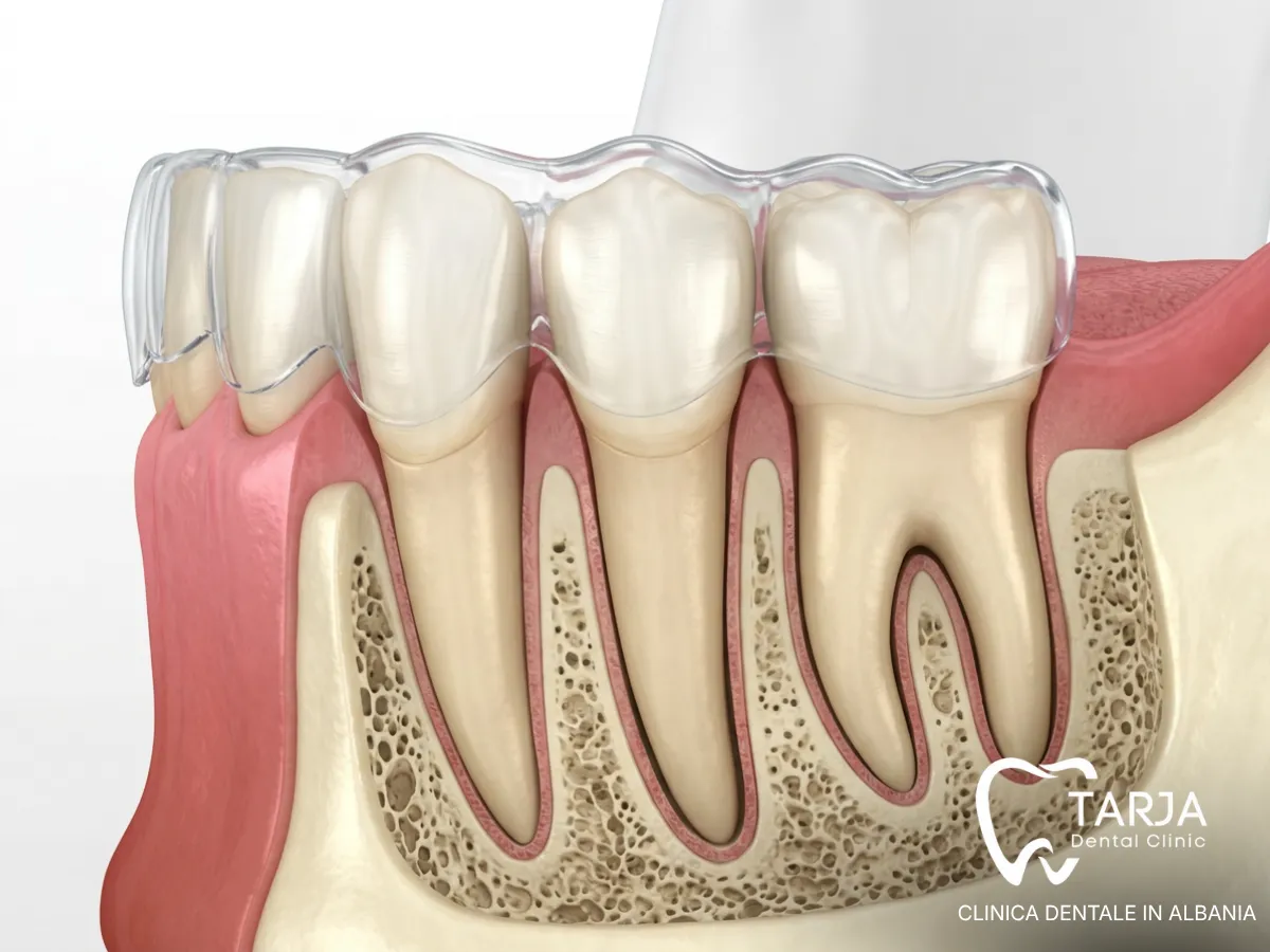 Movimento controllato dei denti affollati con una mascherina trasparente