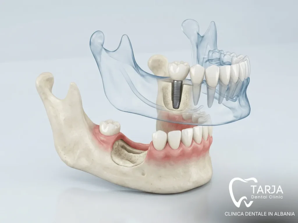 Pianificazione implantare per ottenere denti fissi con poco osso