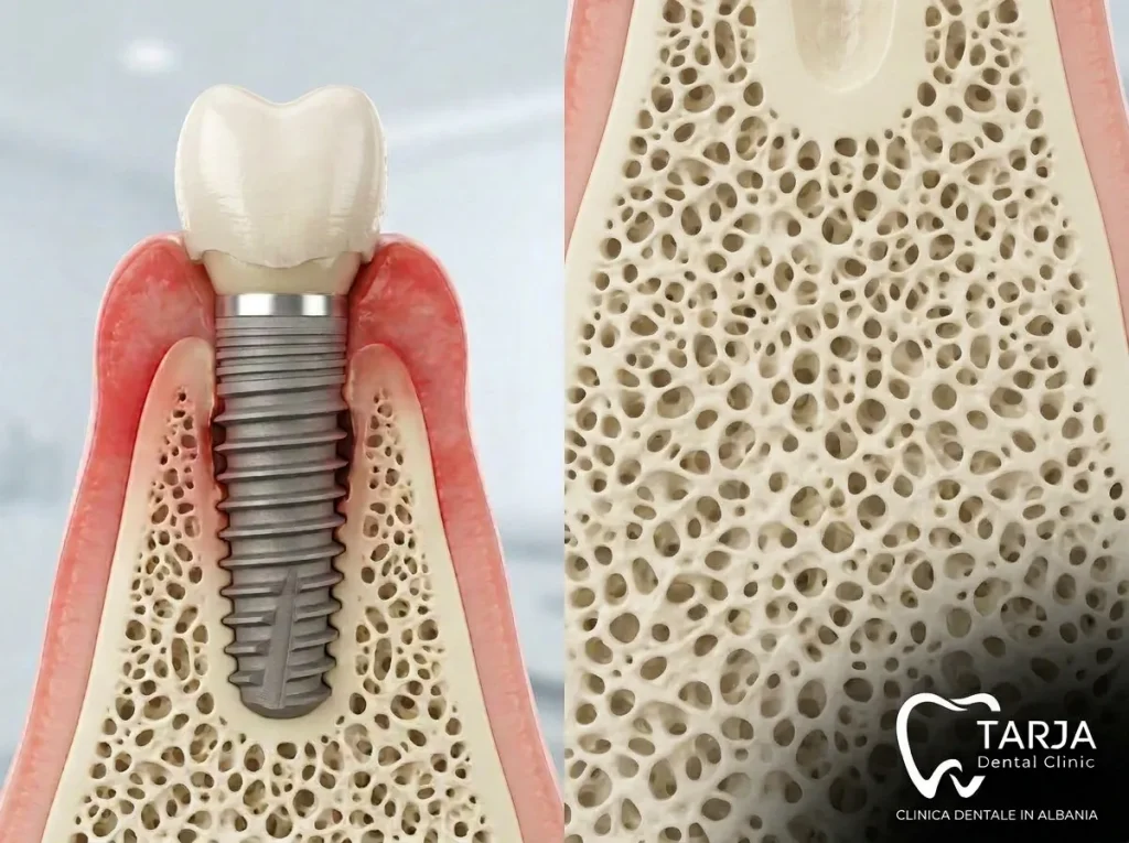 Denti fissi subito dopo impianti dentali con corona provvisoria
